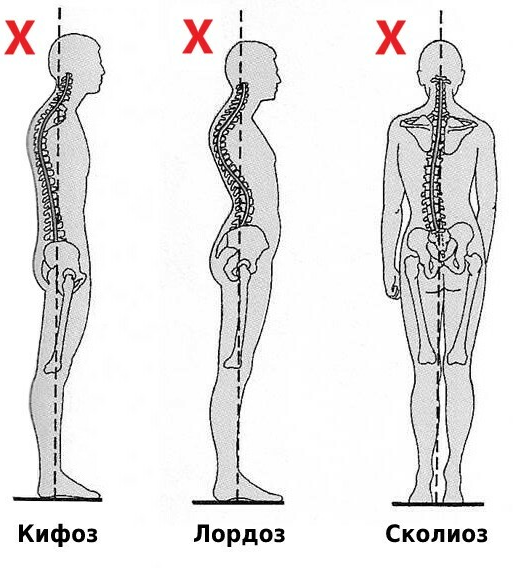 Позвоночник и осанка. Кифоз лордоз и сколиоз позвоночника. Скелет позвоночника лордоз кифоз. Искривление позвоночника кифоз и лордоз. Искривление осанки кифоза.