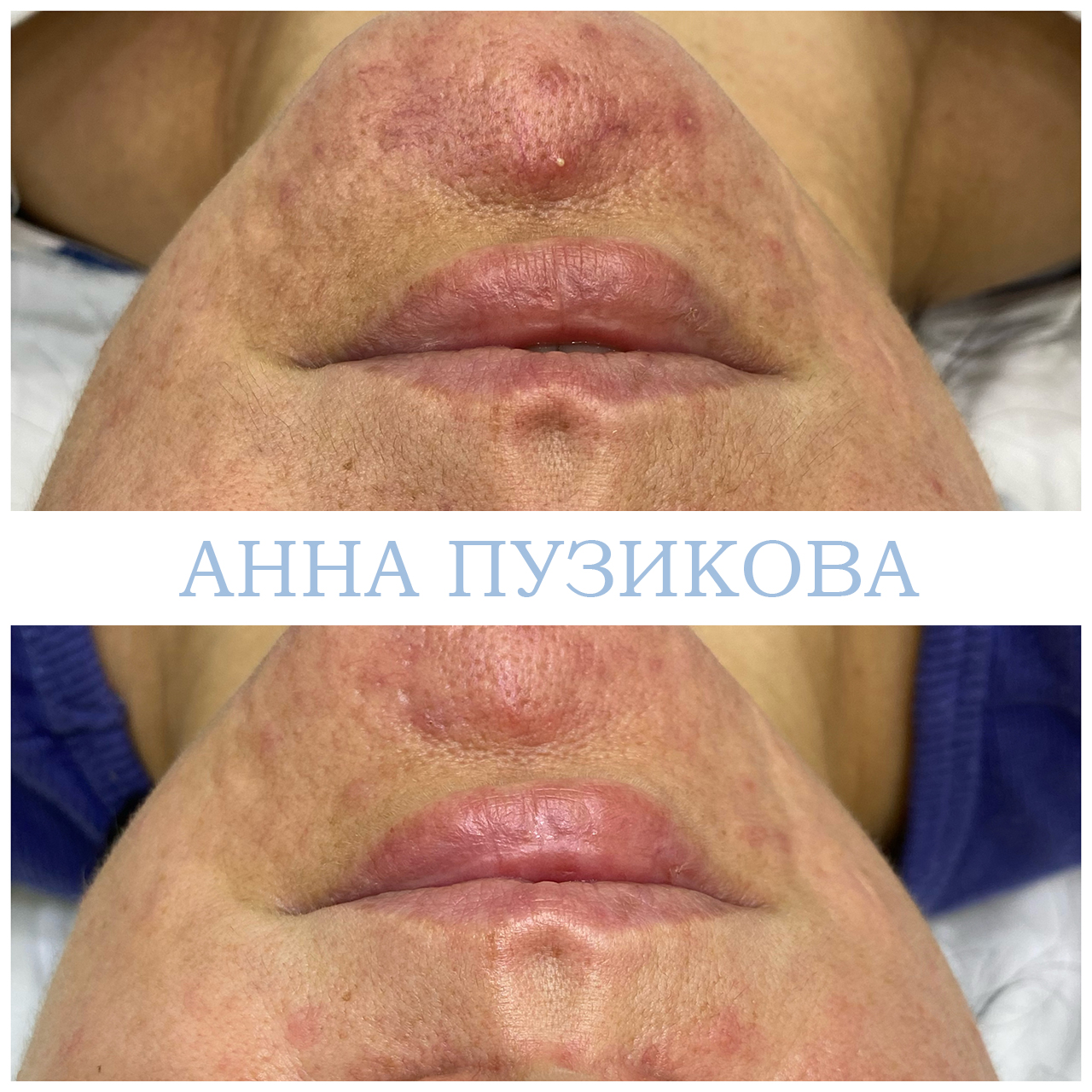 Результат удаления сосудистых звёздочек и купероза на лице с помощью фототерапии ClearLight IPL — врач-косметолог Пузикова Анна Анатольевна, Санкт-Петербург