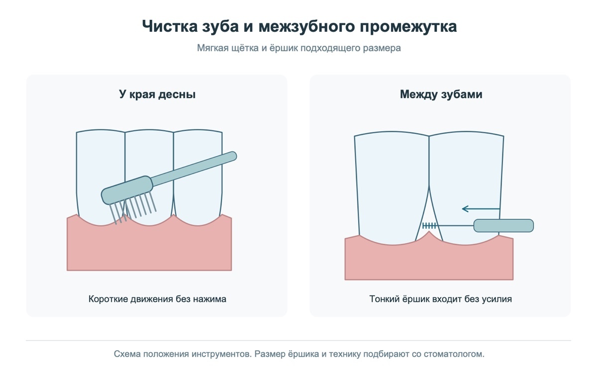 Ежедневная чистка зубов и межзубных промежутков