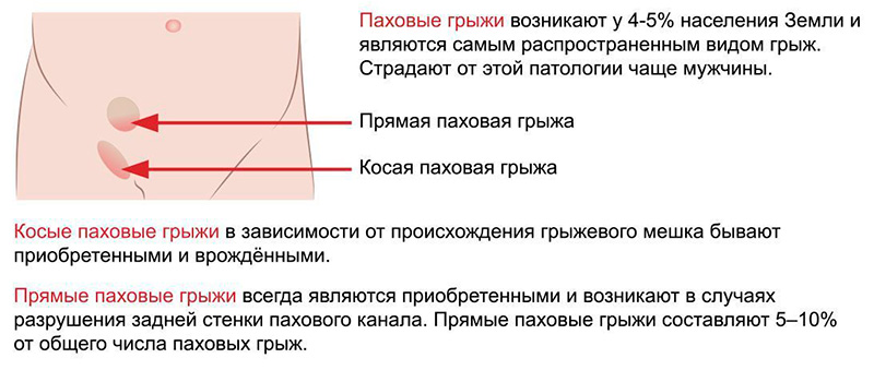 Паховая грыжа - лечение в Москве в Университетской клинике МГУ им. М.В. Ломоносова