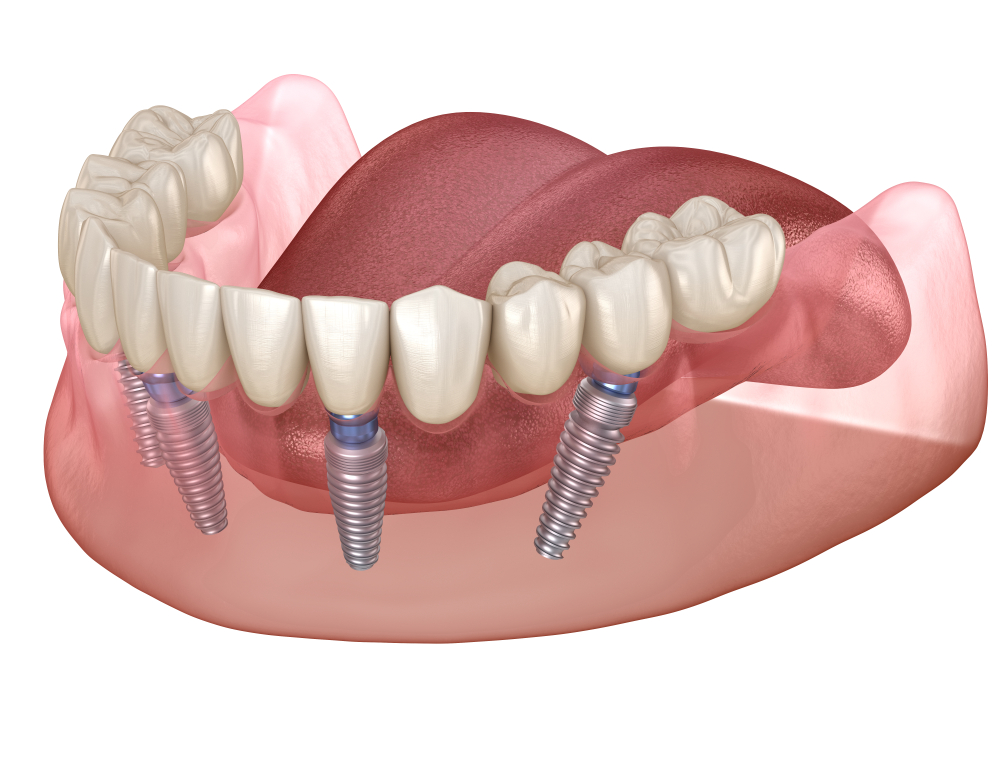 Несъемные протезы форум. Балочный протез на 4 имплантах. Ab Dental имплантаты. На 4 имплантах all-on-4 имплантация.