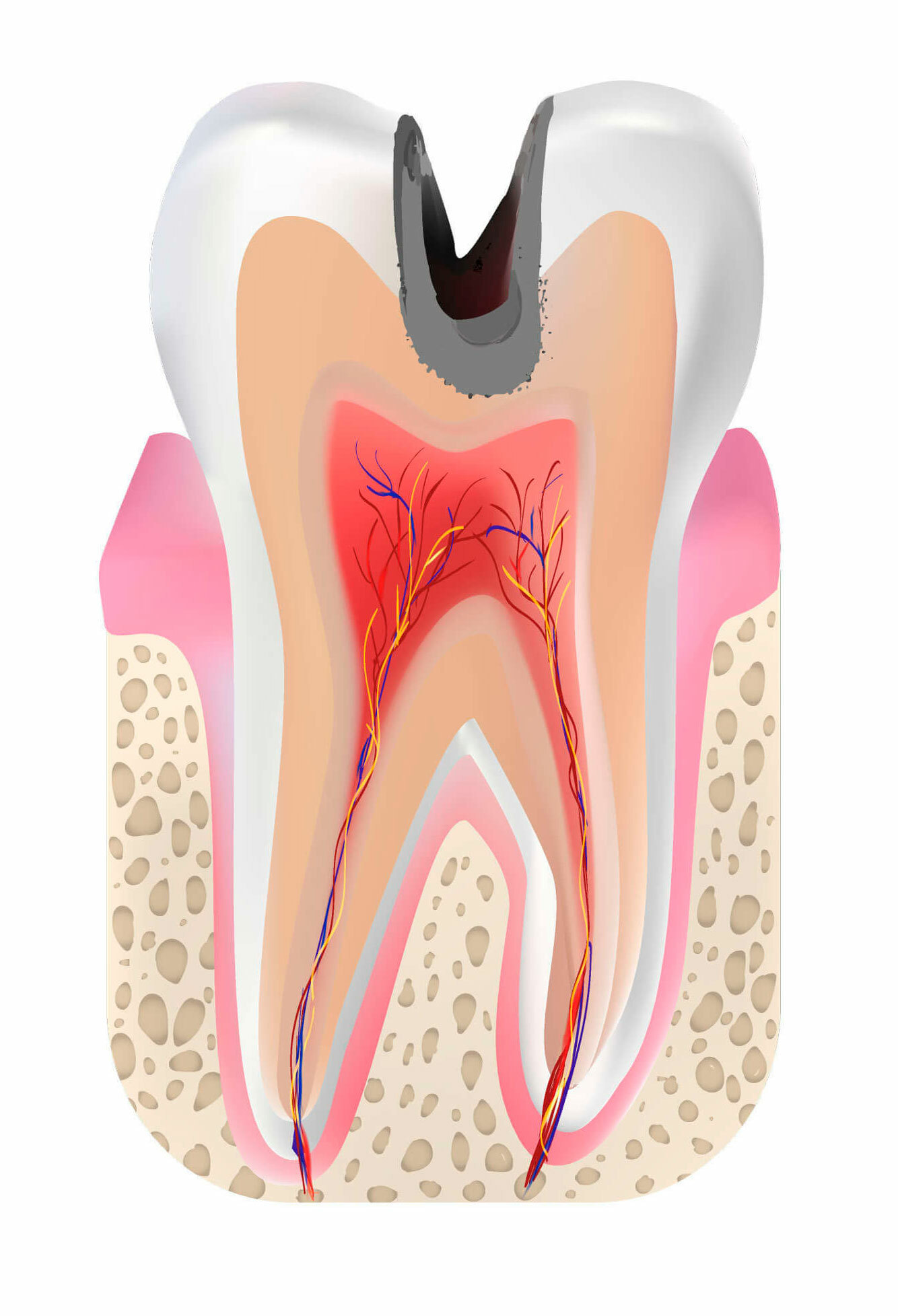 Лечение кариеса