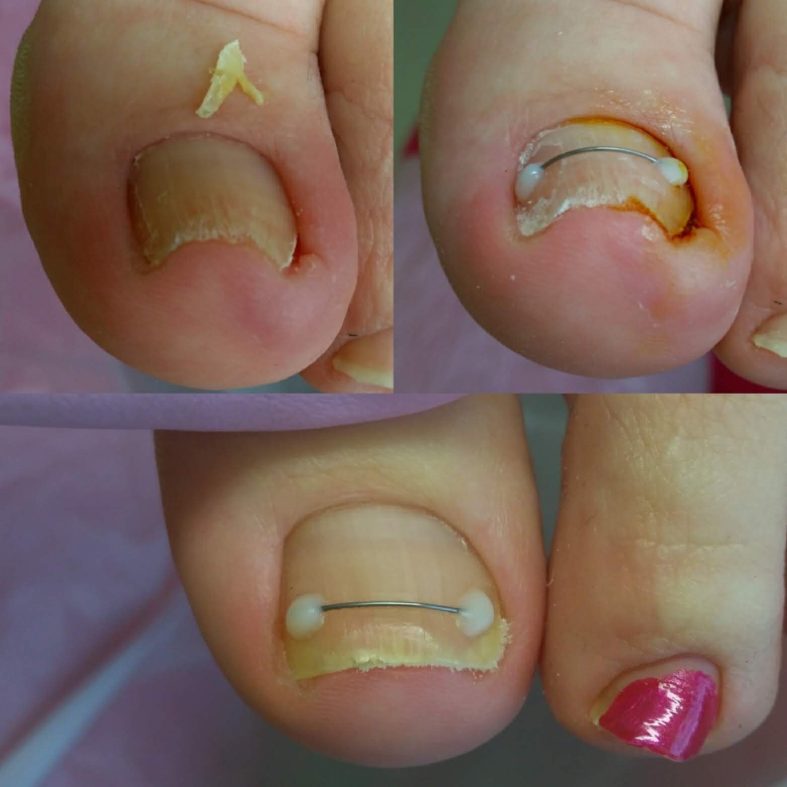 Лечение и удаление вросшего ногтя в Перми без боли по доступной цене ...