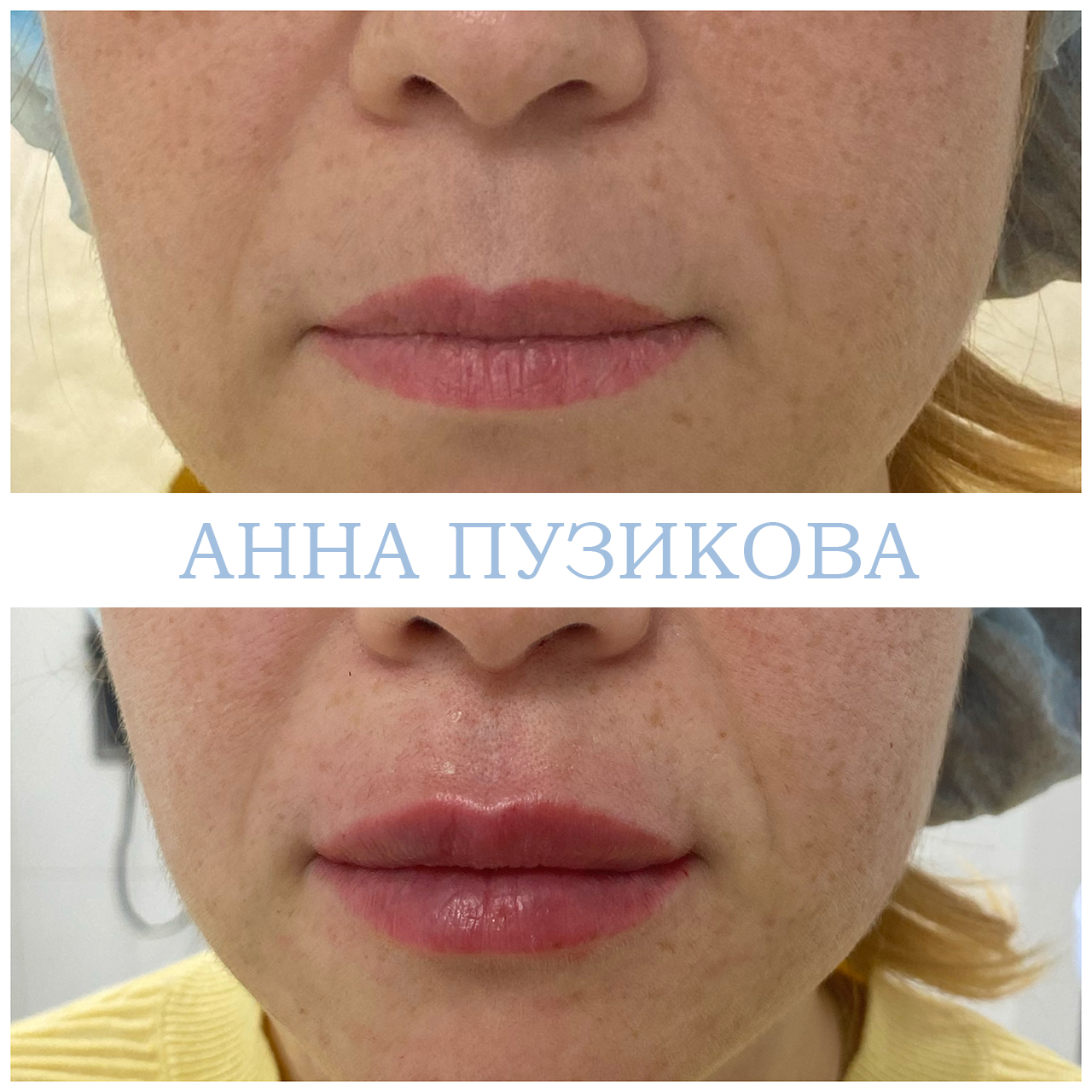 Контурная пластика губ гиалуроновым филлером — естественный результат без утраты пропорций. Косметолог Пузикова Анна Анатольевна, Санкт-Петербург.