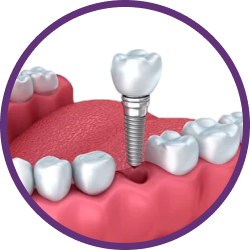 Установка имплантов в Дербенте. Имплантация при отсутствии одного зуба.