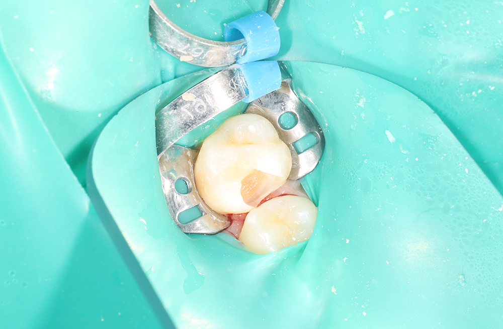 Лечение среднего кариеса подростку 14 лет с применением пломбировочного материала Гармонайз