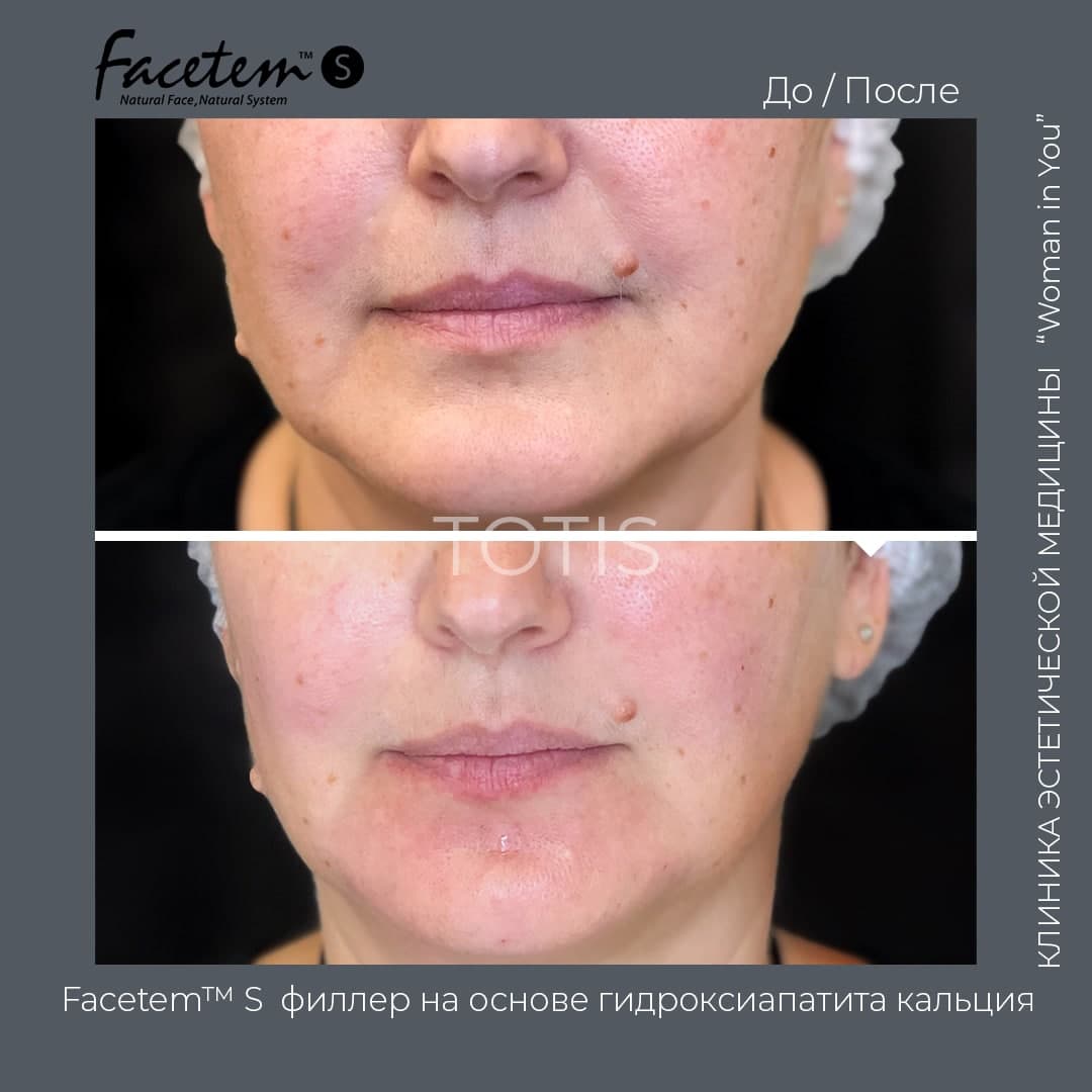 Показания к коррекции кожи лица при деформационно-отечном типе старения: до и после фото, результат применения Facetem S