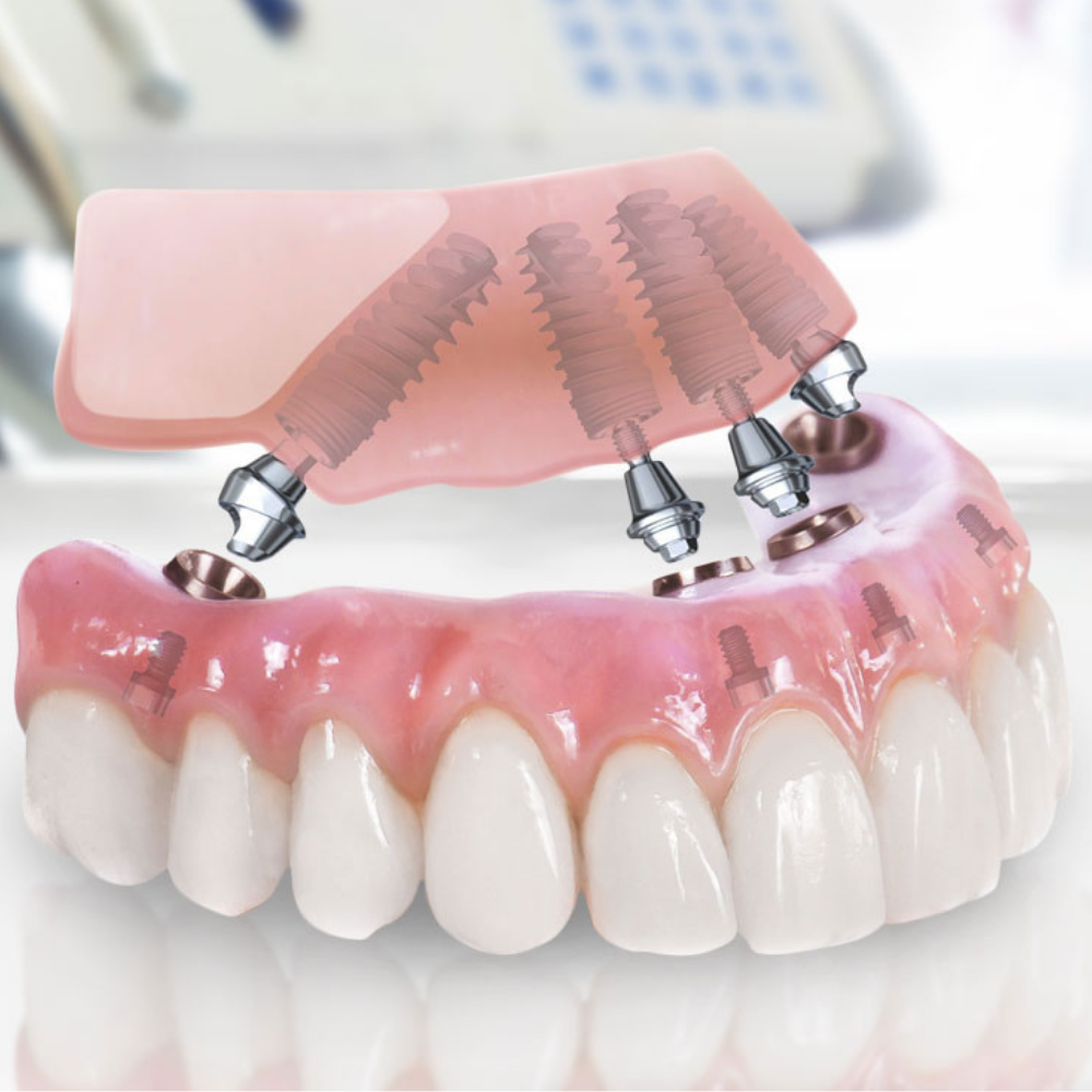 Зубной протез на 4 имплантах. Имплантация зубов all on 4.