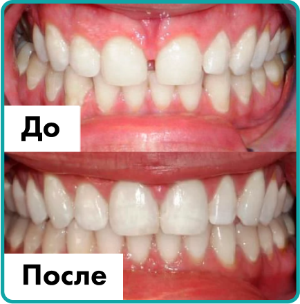 Установка имплантов в Дербенте. Имплантация при отсутствии одного зуба.