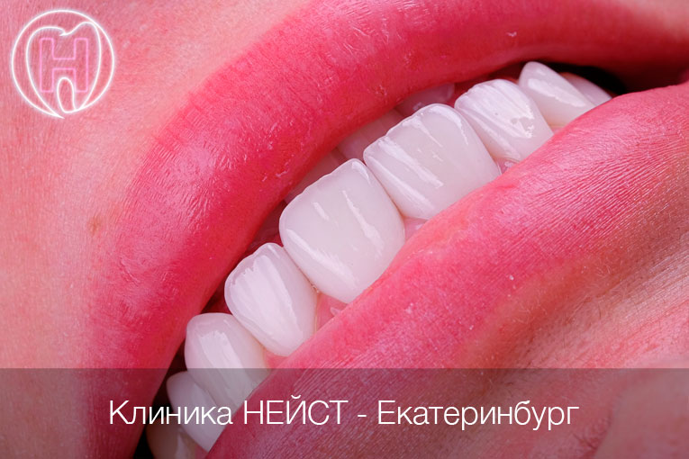 керамические виниры цвет Блич 2 (Bleach2)