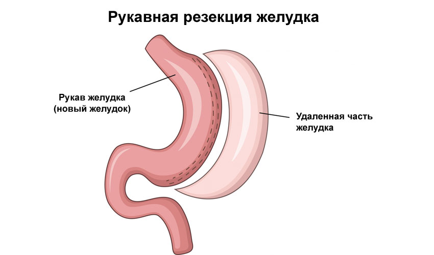 Резекция желудка для похудения фото