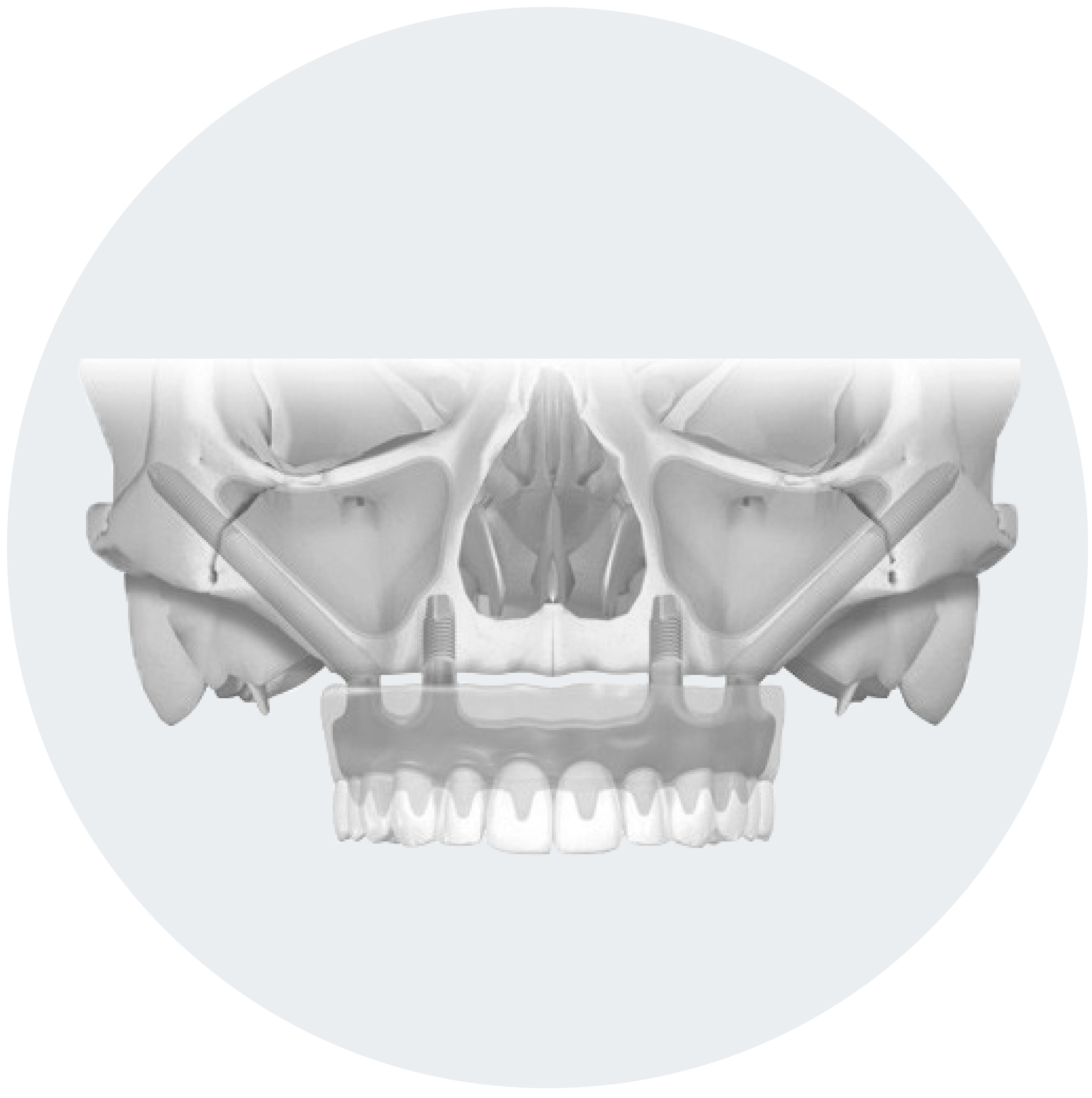 Скуловые импланты. Скуловой имплант Nobel Zygoma. Имплантаты Zygoma Nobel Biocare.