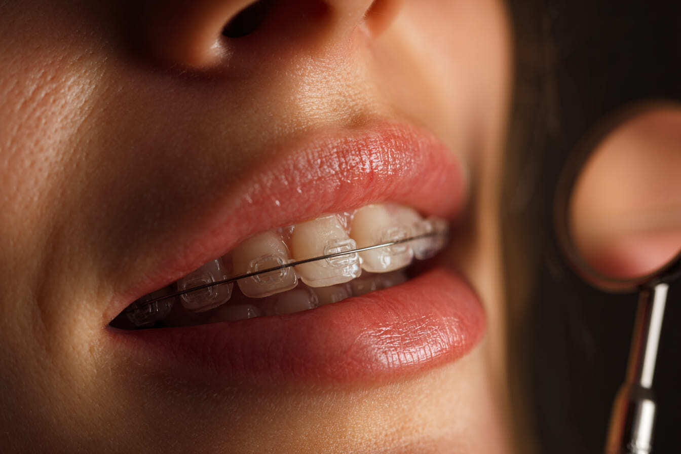 Исправление прикуса с помощью брекетов в Москве