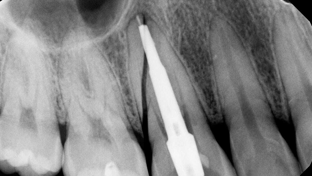Вертикальный перелом корня