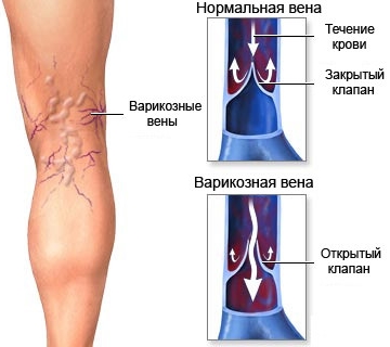 Варикозное расширение вен. Лечение и профилактика