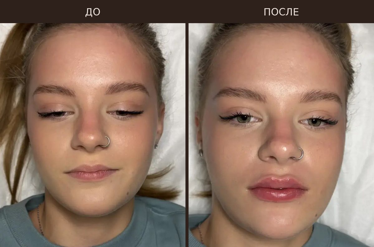 Увеличение губ гиалуроновой кислотой — до и после, Тольятти