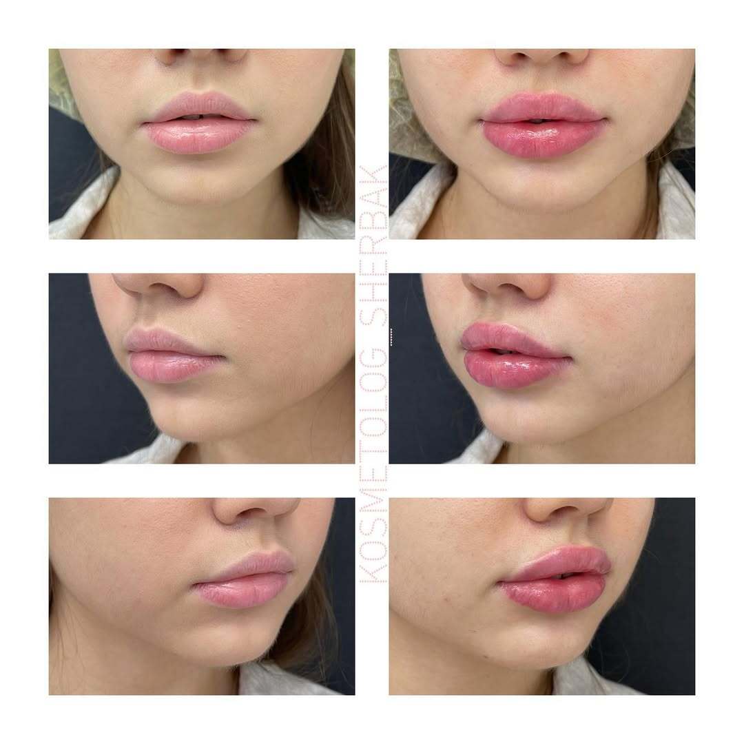 До и после контурной пластики губ. Увеличение объёма без утяжеления. PradusCOSMO, Васильевский остров