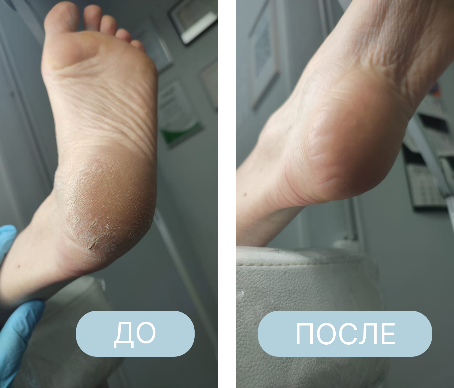 вросший ноготь на ноге, вросший ноготь, удаление вросшего ногтя, вросший ноготь лечение, вросший ноготь операция, удалить вросший ноготь, вросший ноготь цена