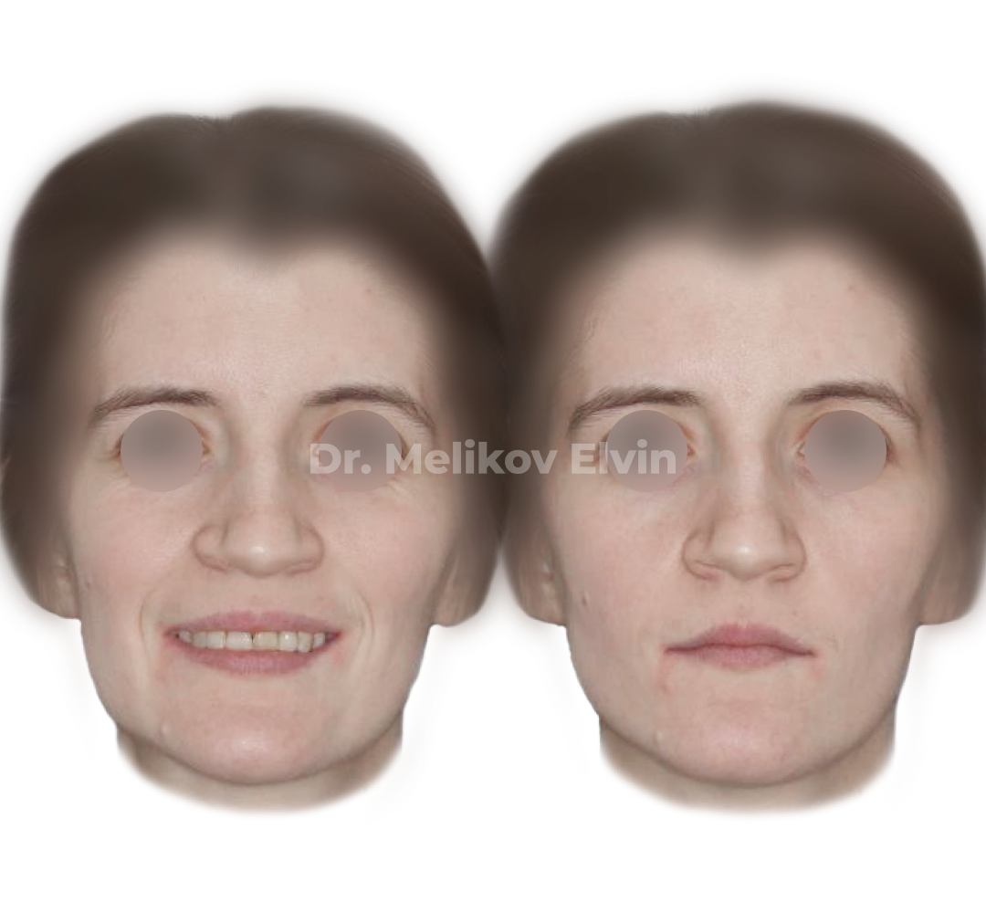 Фотографии после ортогнатической операции.