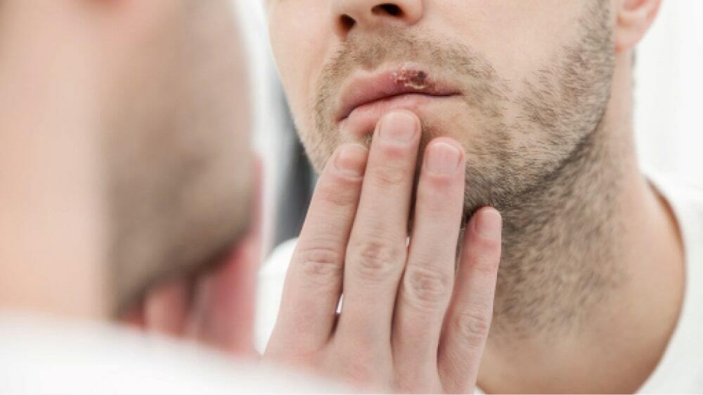 Мужчина смотрит на свой рот с герпетической инфекцией в зеркале.