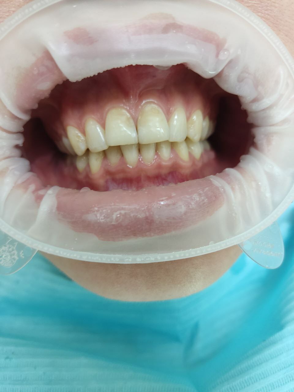 Ламинаты на зубы