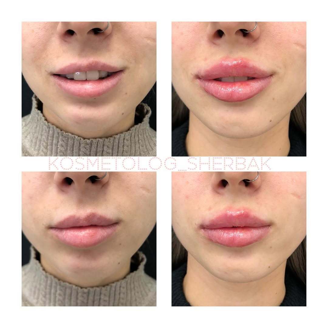 До и после контурной пластики губ. Увеличение объёма без утяжеления. PradusCOSMO, Васильевский остров