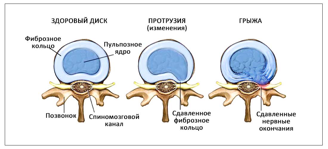 Протрузия это. Межпозвоночная грыжа пульпозное ядро. Протрузия межпозвонкового диска. Строение межпозвонкового диска человека. Межпозвонковый диск строение.