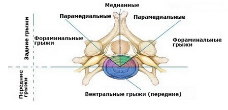 Что такое грыжа позвоночника парамедианная грыжа. Смотреть фото Что такое грыжа позвоночника парамедианная грыжа. Смотреть картинку Что такое грыжа позвоночника парамедианная грыжа. Картинка про Что такое грыжа позвоночника парамедианная грыжа. Фото Что такое грыжа позвоночника парамедианная грыжа