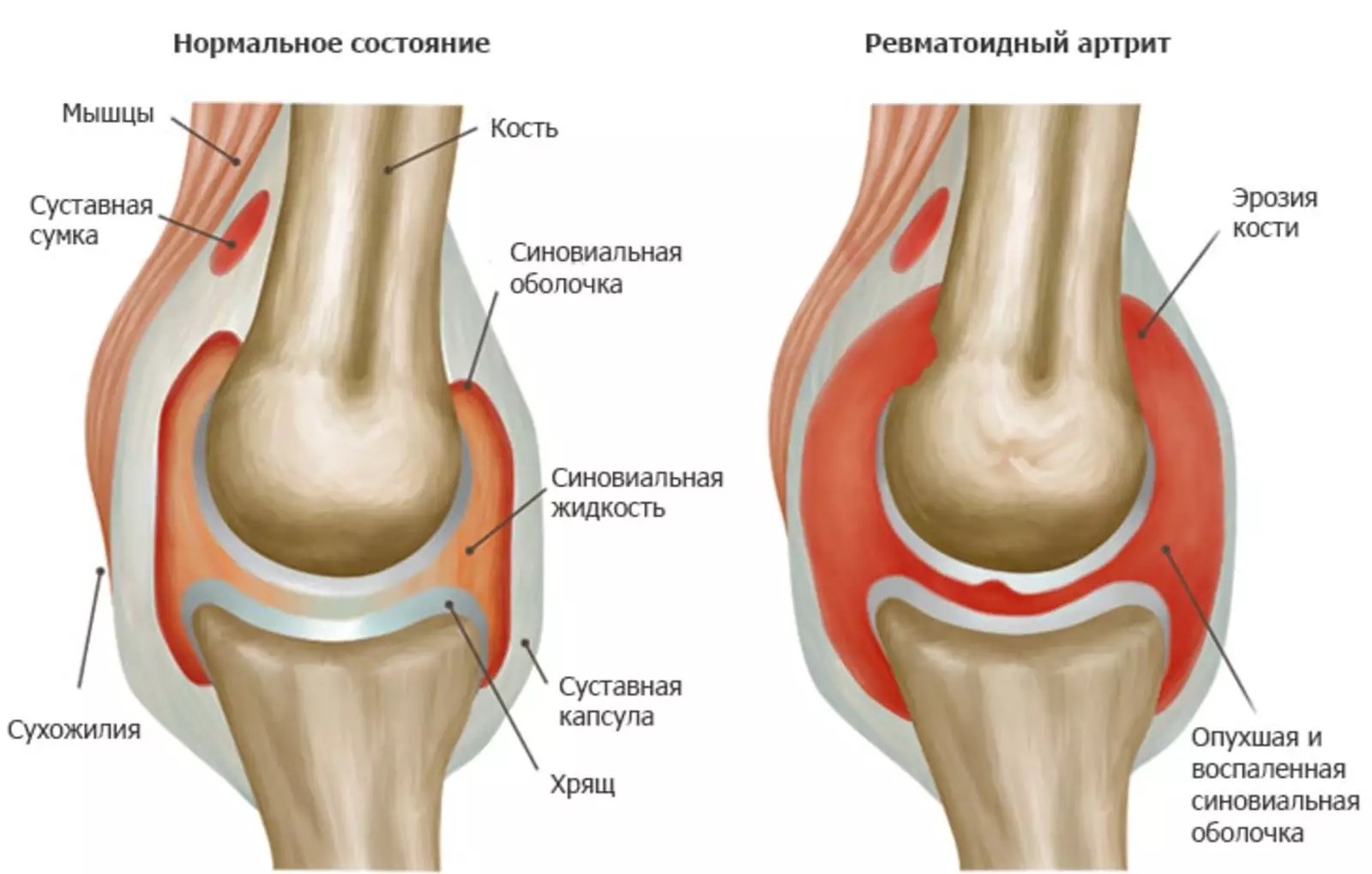 Артрит что это. Синовиальная мембрана коленного сустава. Ревматоидный артрит коленного сустава. Ревматоидный артрит колена. Ревматоидный артрит и здоровый сустав.