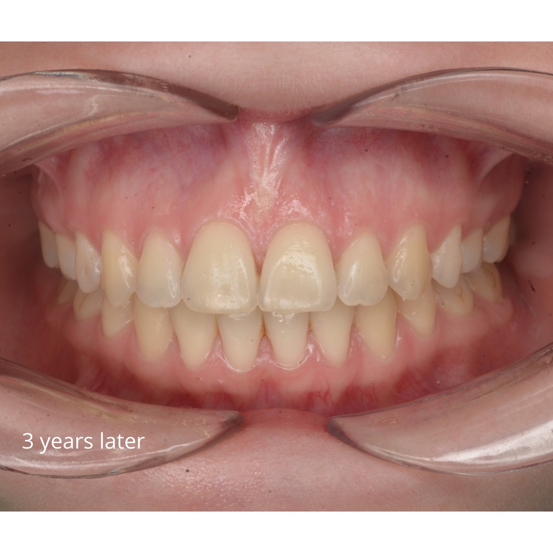 After treatment: wide, symmetric smile with corrected Class II bite — photo 7 of 7