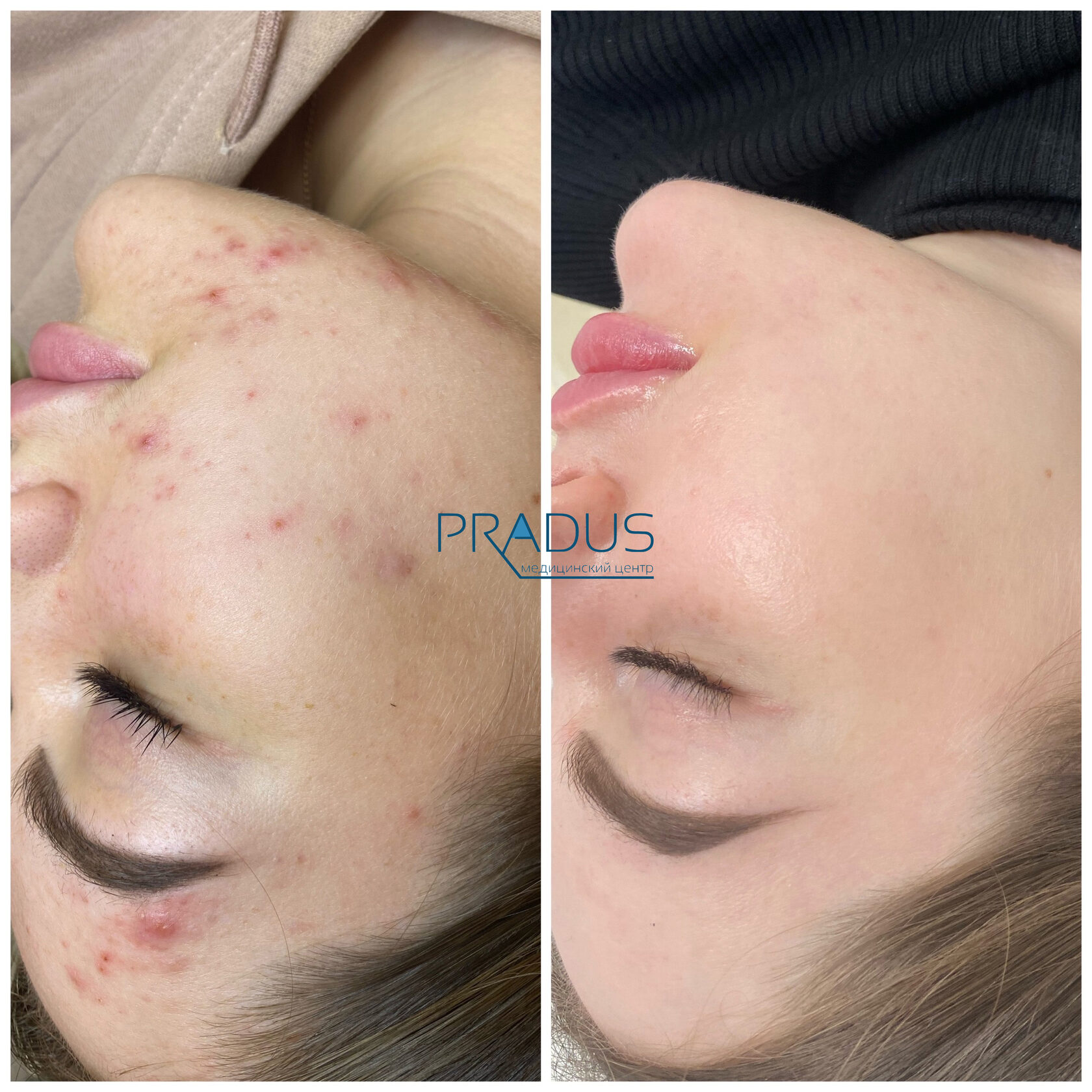 Лечение акне у женщины в клинике PradusCOSMO, СПб. До и после процедуры
