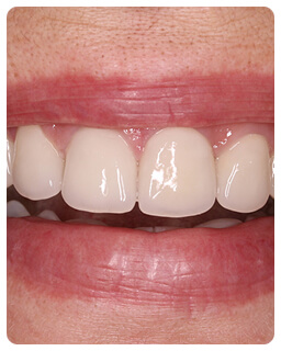 Имплантация в стоматологии Дент-Арт