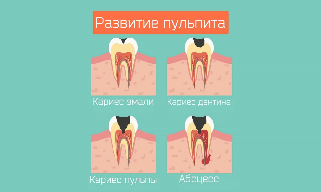 Кариес причины. Стадии поражения кариесам. Стадии развития острого пульпита.