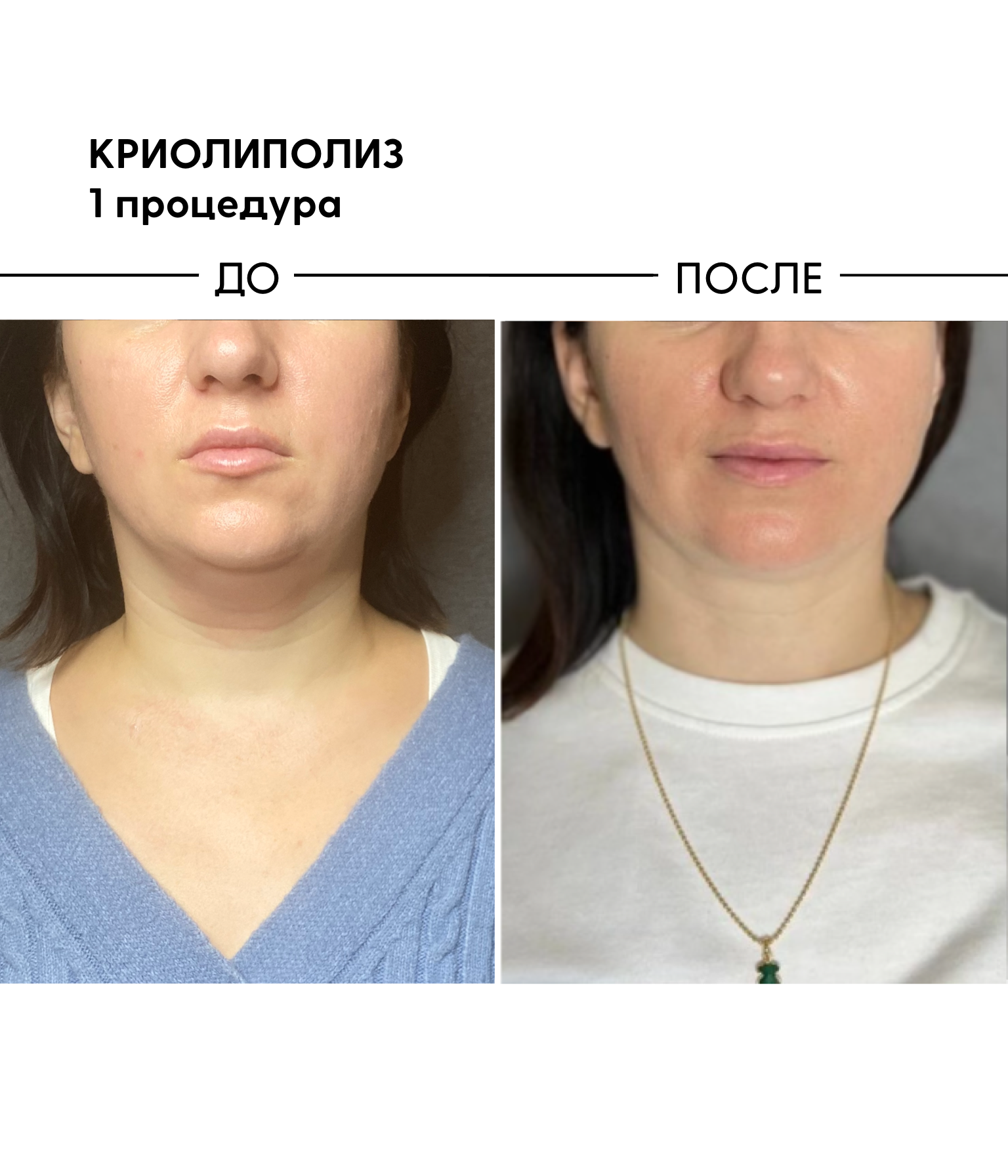 Криолиполиз подбородка