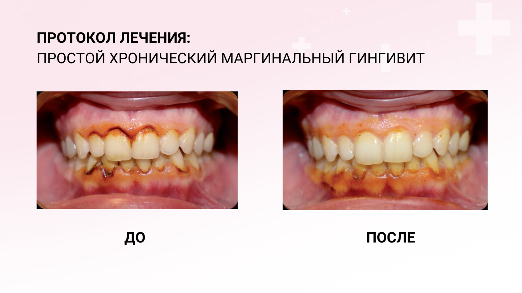 После чистки болят зубы: причины, что делать и как снять боль
