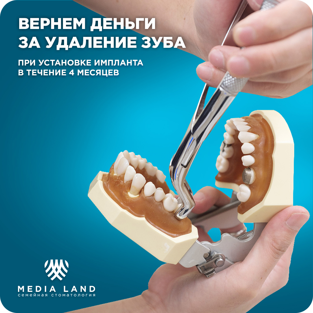 Имплантация зубов по акции: возвращаем деньги за удаление.