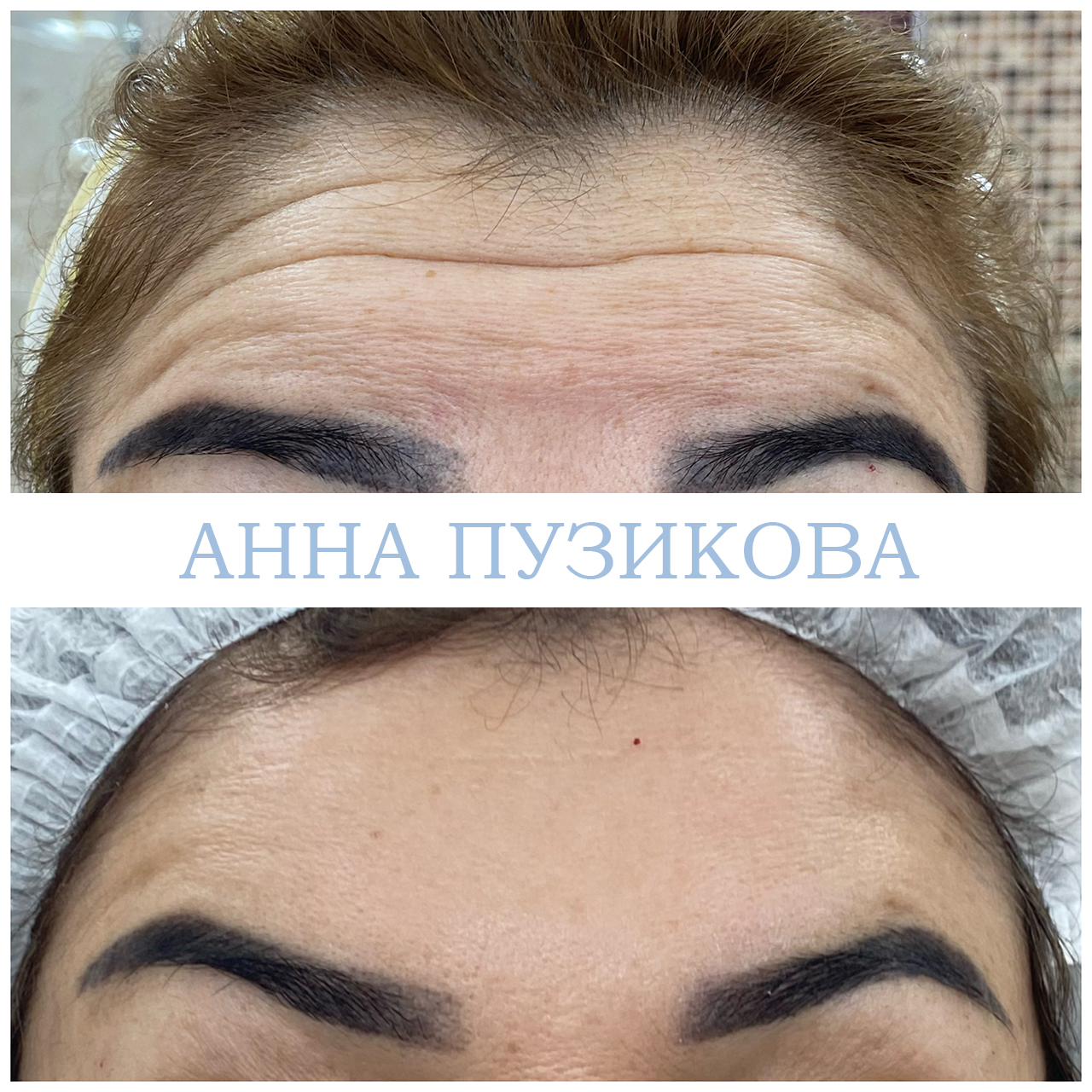 Результат ботулинотерапии — коррекция мимических морщин на лбу и в области глаз. Косметолог Пузикова Анна Анатольевна, Санкт-Петербург