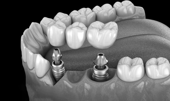 Dental Implant-Supported Bridge Implant Supported Bridges Houston Puente dental,