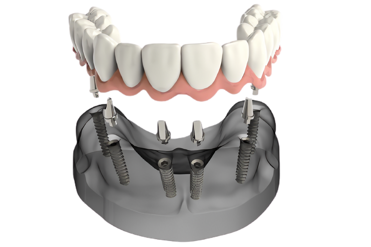 Имплантация зубов all on 6. Протез нижней челюсти на 4 имплантах. Имплантация зубов all on 4.