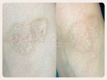 удаление шрама после ожога москва до после