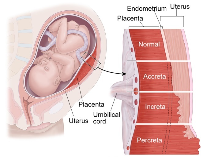 Плацента при беременности.