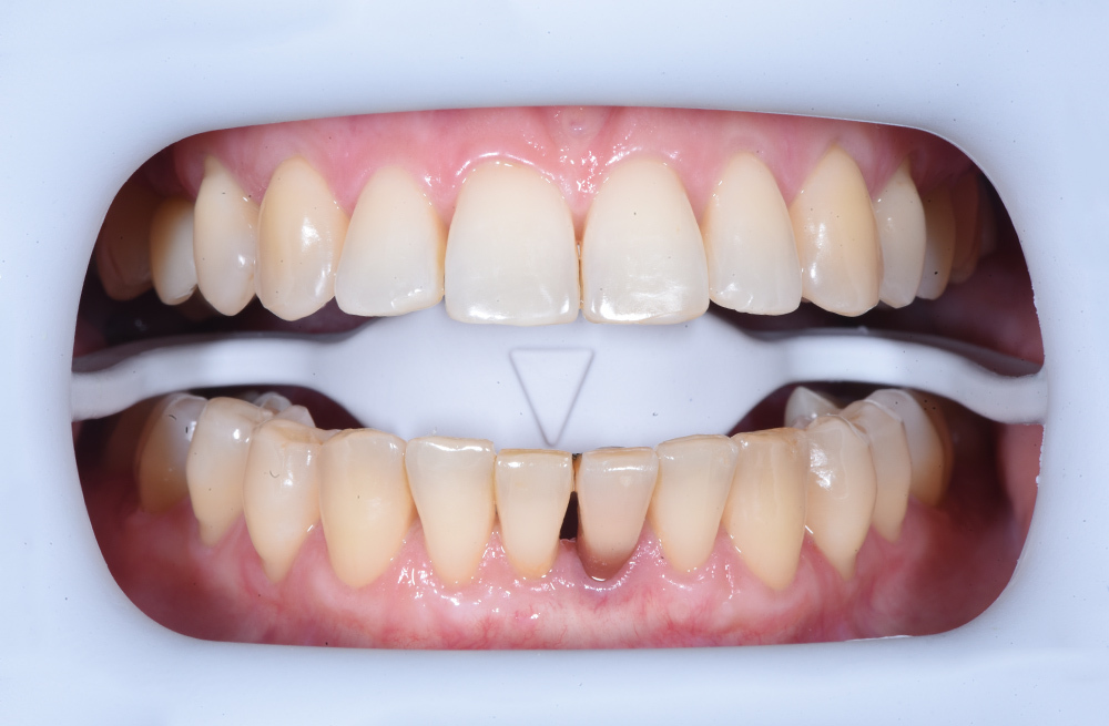 Осветление эмали до эстетически комфортного оттенка методом кабинетного отбеливания