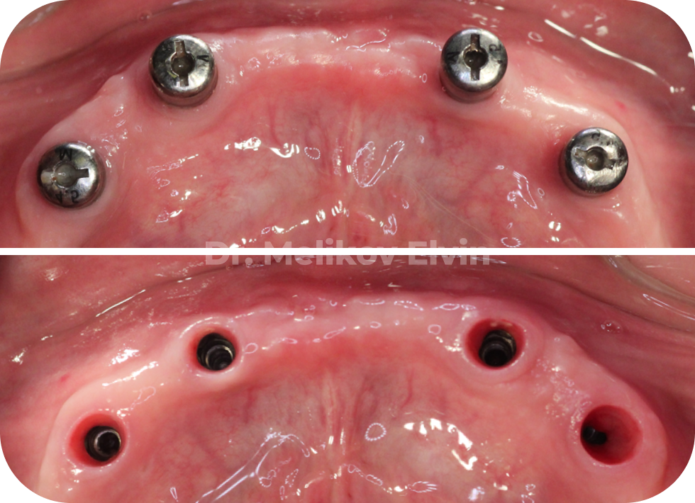 Ортопедические коронки на винтовой фиксации для нижней челюсти.