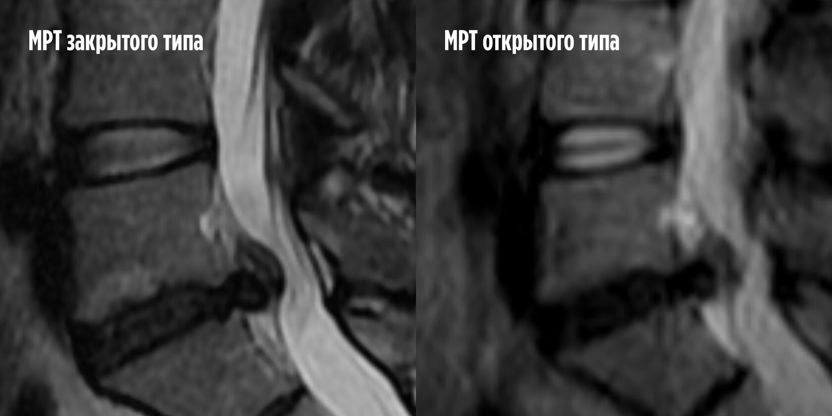 Сравнение снимков межпозвоночной грыжи одного пациента на разных аппаратах МРТ