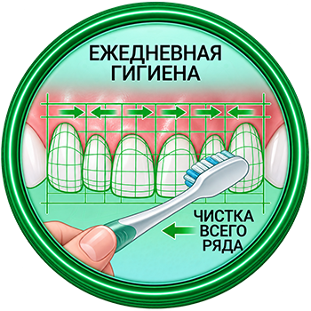 Уход за винирами после фиксации