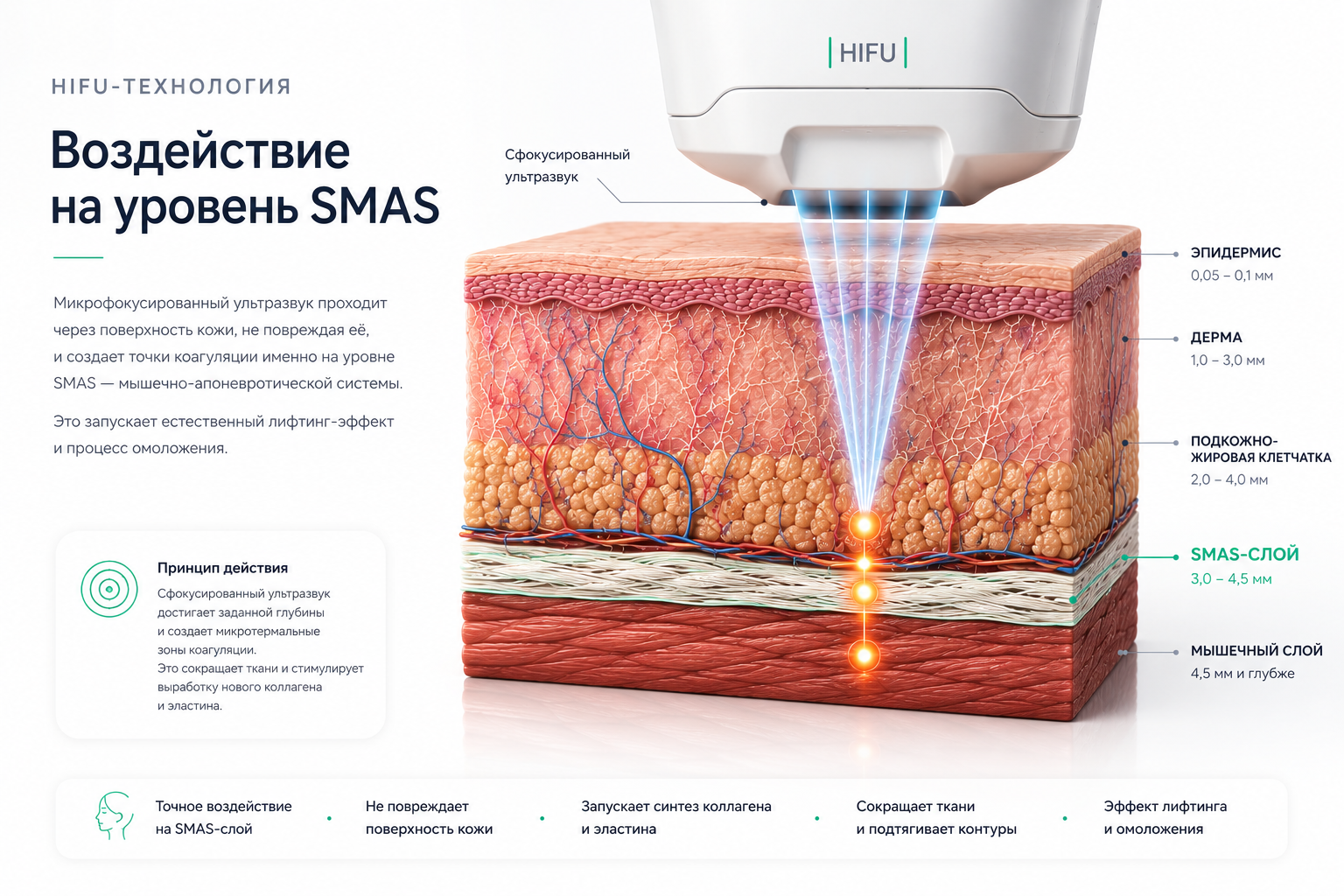 Liftera 2, HIFU и уровень SMAS