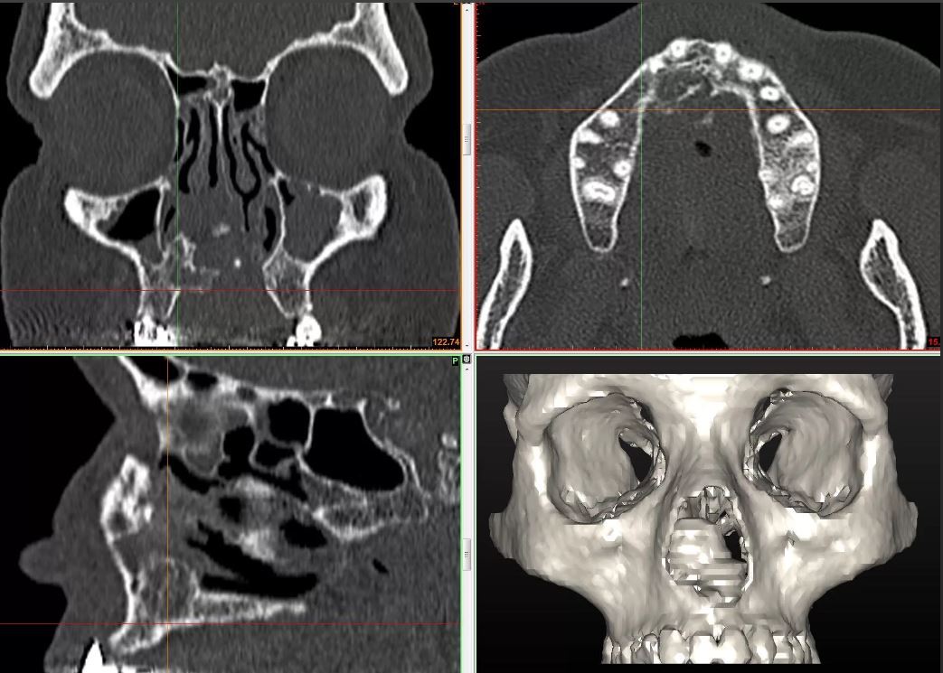 Кт верхней челюсти фото