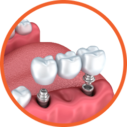 Установка имплантов в Дербенте. Имплантация при отсутствии одного зуба.
