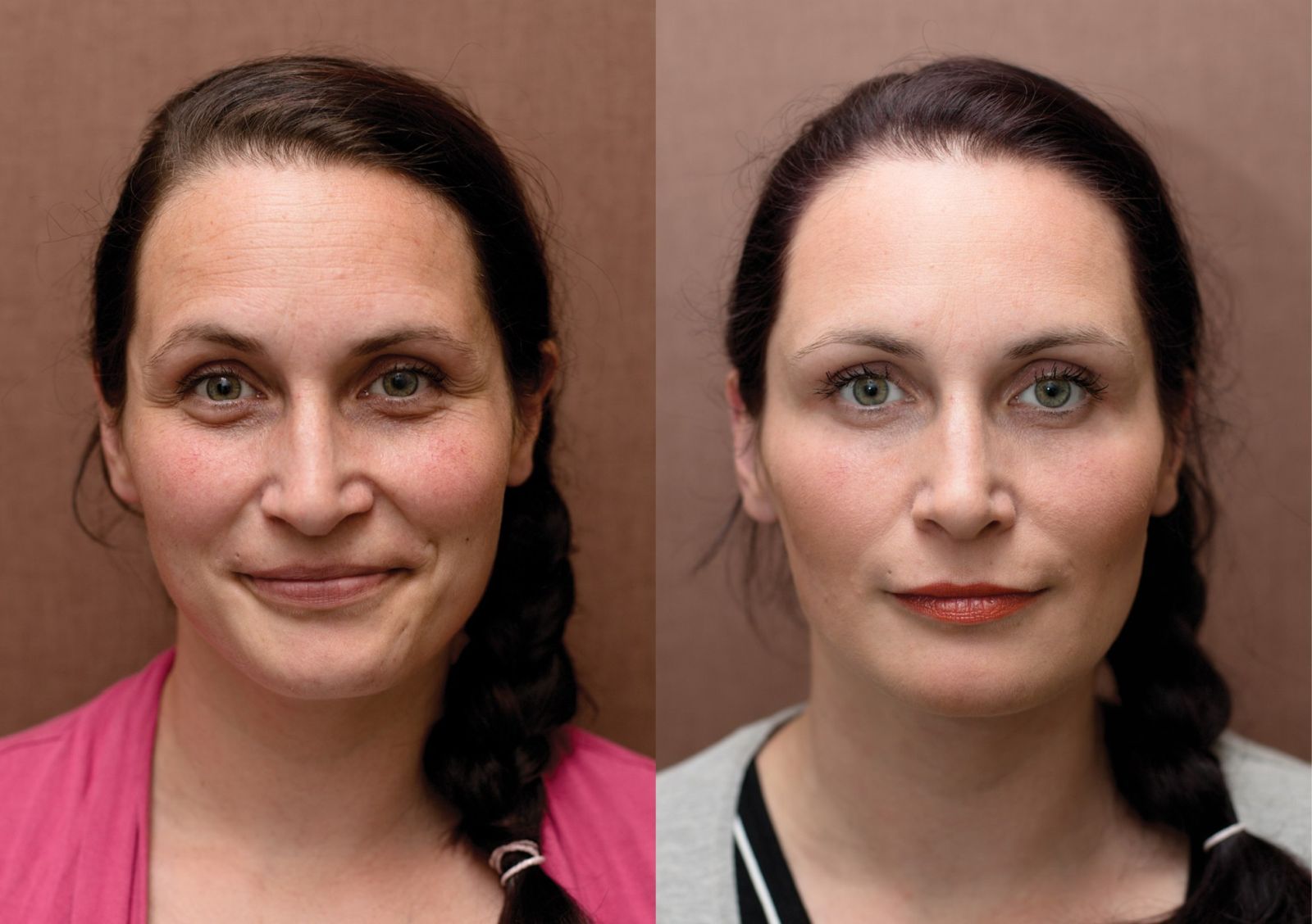 Мезотерапия глаз до и после фото