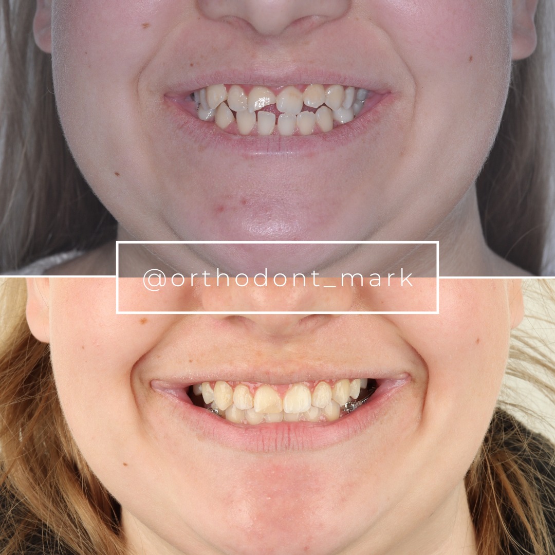 Agenesis Management with Space Planning for Prosthetic Restoration